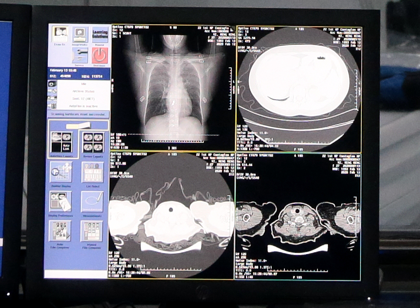 达摩院最新AI诊断技术：新冠肺炎CT影像识别准确率达96%！