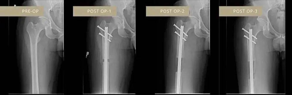 Google、微软工程师花几十万把腿弄断，这件事在硅谷越来越流行