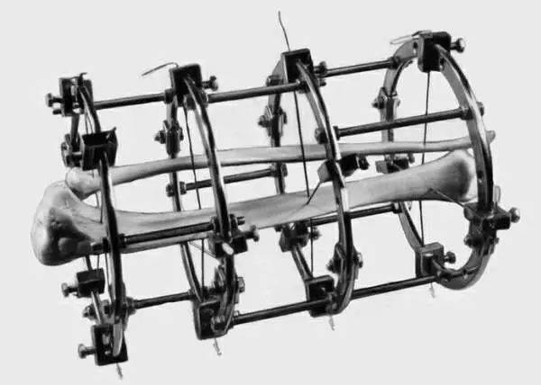 Google、微软工程师花几十万把腿弄断，这件事在硅谷越来越流行