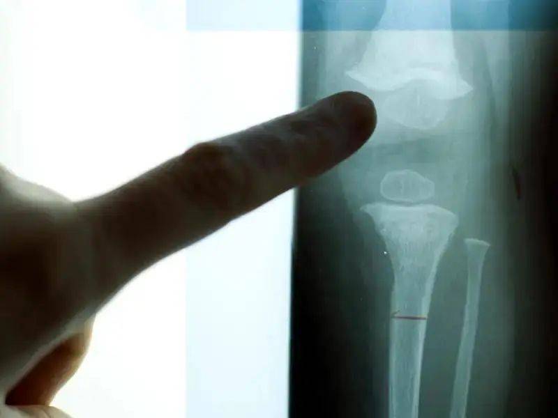 Google、微软工程师花几十万把腿弄断，这件事在硅谷越来越流行