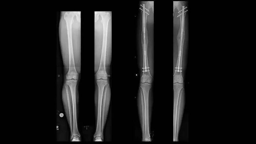 Google、微软工程师花几十万把腿弄断，这件事在硅谷越来越流行