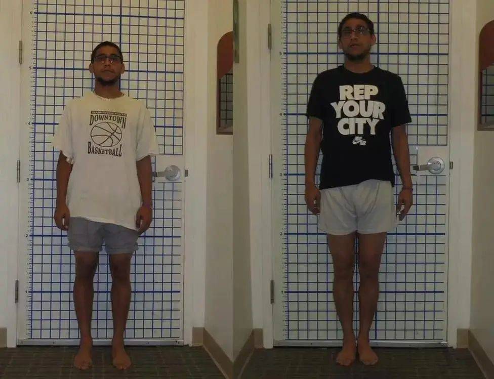 Google、微软工程师花几十万把腿弄断，这件事在硅谷越来越流行